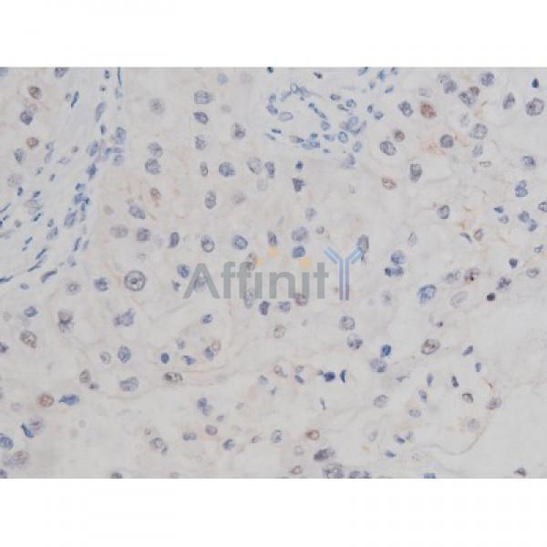 Phospho-Tau (Thr205)[Thr522] Antibody - AF3150 at 1/200 staining Human kidney cancer tissue sections by IHC-P.